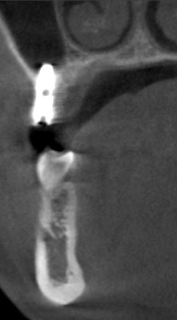 Установленный имплантат без учета 3D - отсутствует шечная поверхность кости